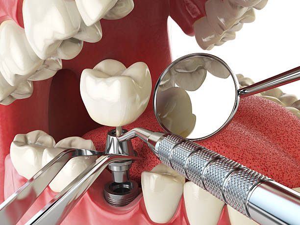 Best Emergency Dental Care for Broken or Chipped Teeth in Fort Calhoun, NE